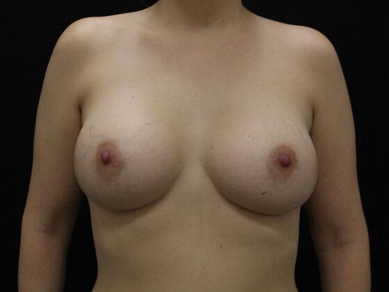Breast Augmentation: Case 120 - After