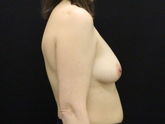 Breast Augmentation: Case 120 - Before