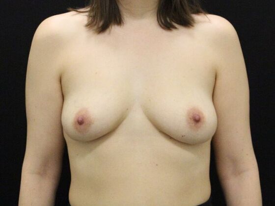 Breast Augmentation: Case 120 - Before