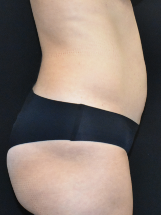 Liposuction: Case 4 - Before