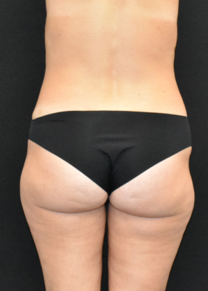 Liposuction Case 4 - Before