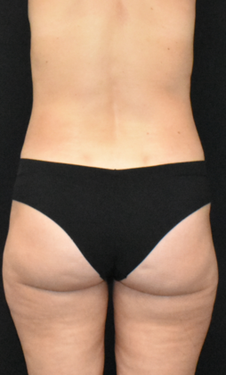 Liposuction Case 4 - After