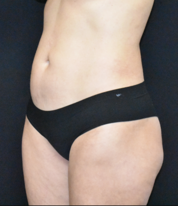 Liposuction: Case 4 - After