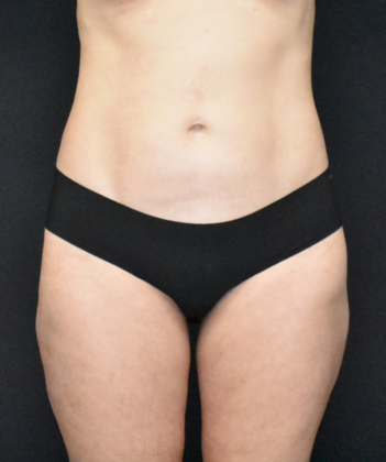 Liposuction: Case 4 - After