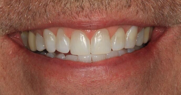 Bonding Case 13 - After