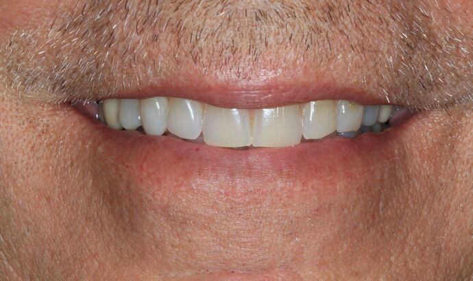 Bonding Case 13 - Before