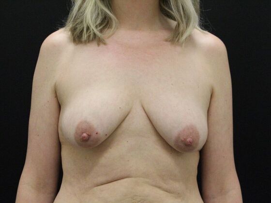 Breast Lift & Breast Lift Augmentation Case 53 - Before