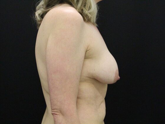 Breast Lift & Breast Lift Augmentation: Case 53 - Before