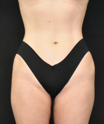 Liposuction Case 5 - After