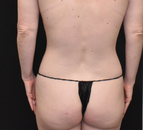 Liposuction: Case 5 - Before