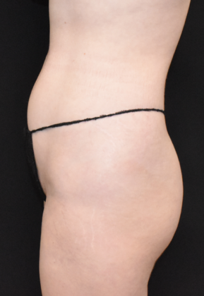 Liposuction: Case 5 - Before