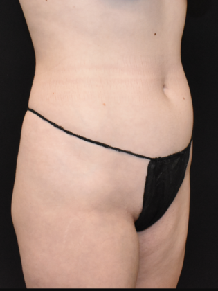 Liposuction: Case 5 - Before