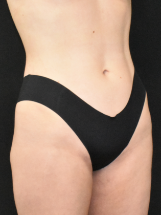 Liposuction: Case 5 - After