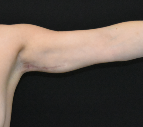 Brachioplasty: Case 5 - After