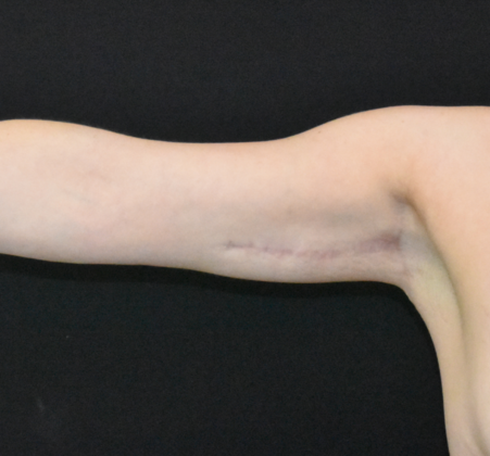 Brachioplasty Case 5 - After