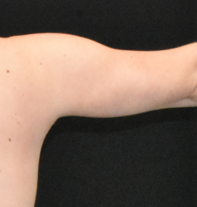 Brachioplasty: Case 5 - After