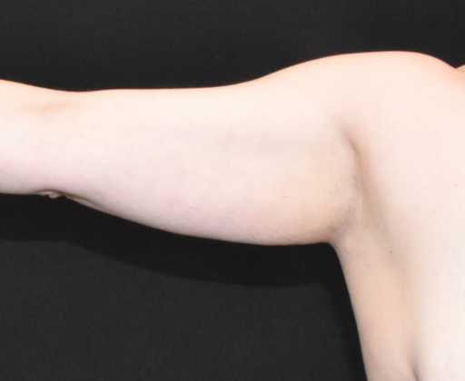 Brachioplasty Case 5 - Before