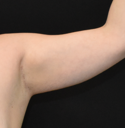 Brachioplasty: Case 5 - Before