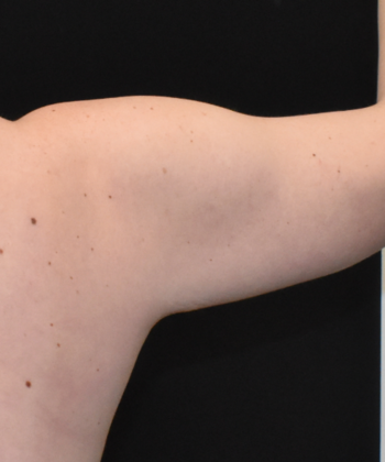 Brachioplasty: Case 5 - Before