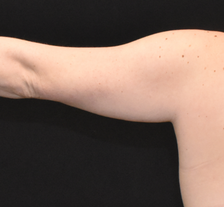 Brachioplasty: Case 5 - Before