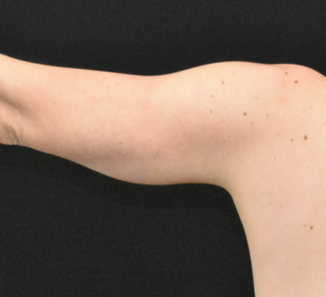 Brachioplasty: Case 5 - After