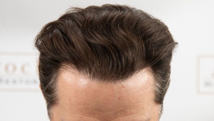 FUT Hair Restoration: Case 50 - After