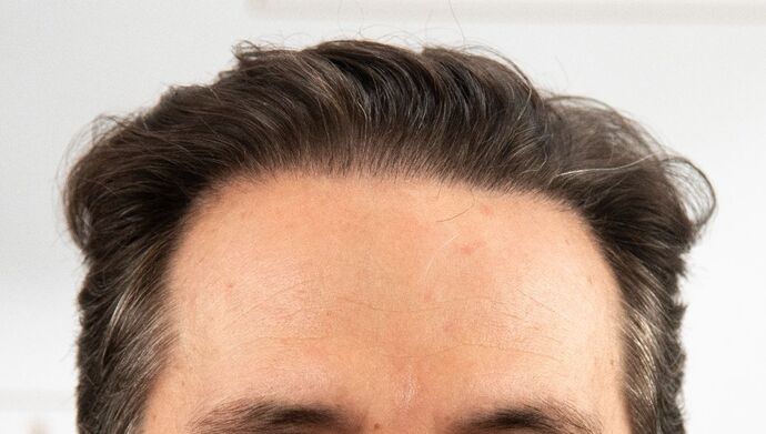 FUT Hair Restoration Case 50 - After