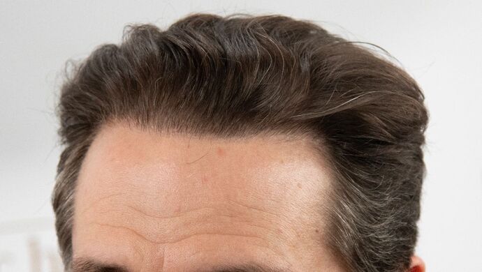 FUT Hair Restoration: Case 50 - After