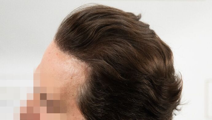 FUT Hair Restoration: Case 50 - After