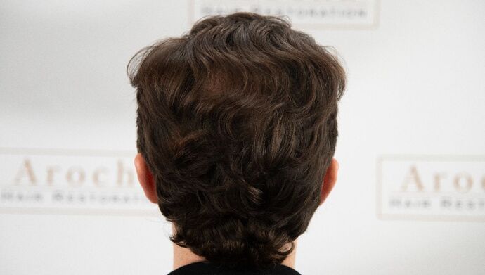 FUT Hair Restoration: Case 50 - Before