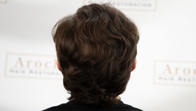 FUT Hair Restoration: Case 50 - Before