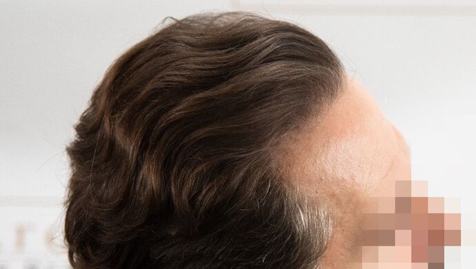 FUT Hair Restoration: Case 50 - After