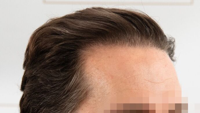 FUT Hair Restoration: Case 50 - After