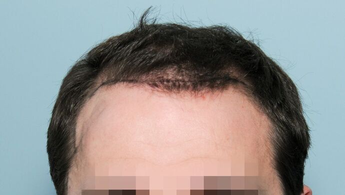 FUT Hair Restoration Case 50 - Before