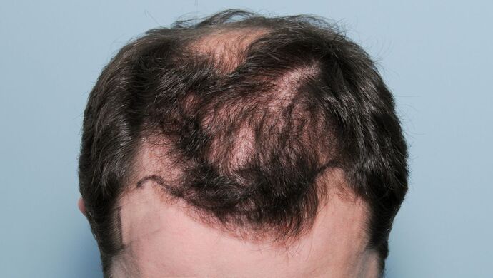 FUT Hair Restoration: Case 50 - Before