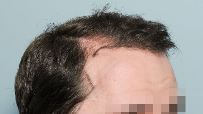 FUT Hair Restoration: Case 50 - Before