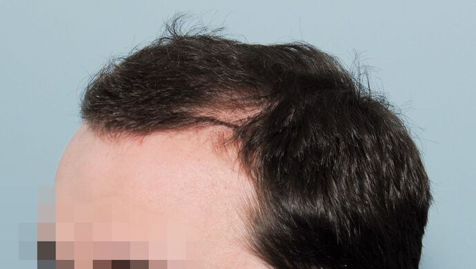 FUT Hair Restoration: Case 50 - Before