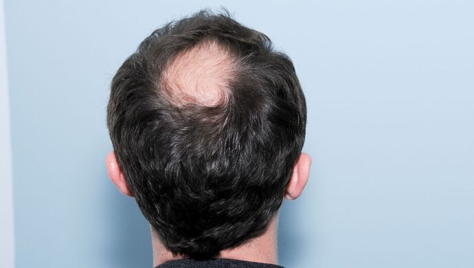 FUT Hair Restoration: Case 50 - After