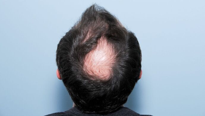 FUT Hair Restoration: Case 50 - After