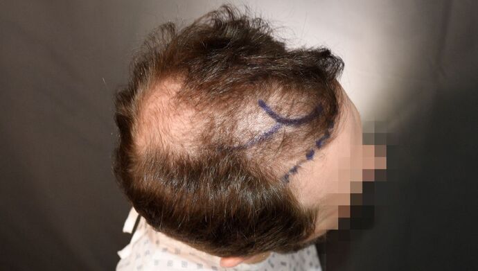 FUT Hair Restoration: Case 50 - Before