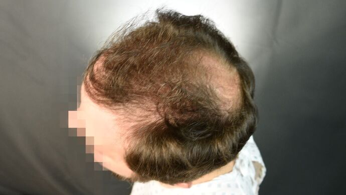 FUT Hair Restoration: Case 50 - Before