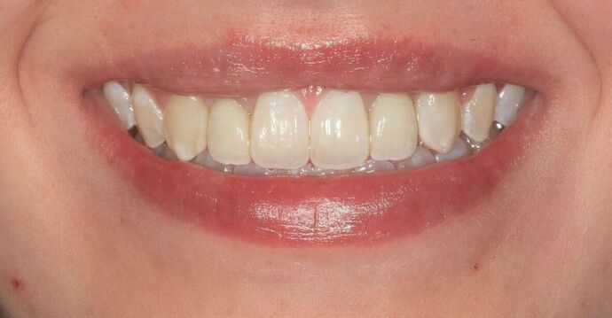 Dental Implants Case 13 - After