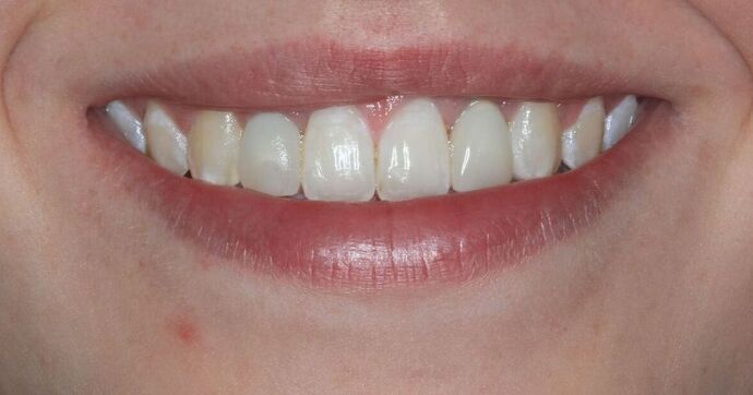 Dental Implants Case 13 - Before