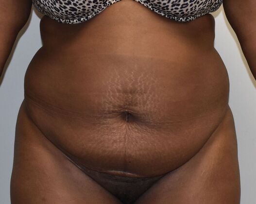 Tummy Tuck (Abdominoplasty): Case 524 - Before