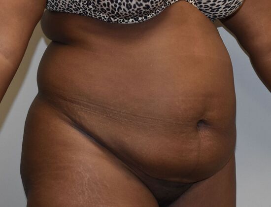 Tummy Tuck (Abdominoplasty): Case 524 - Before