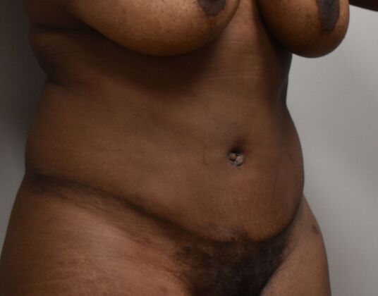 Tummy Tuck (Abdominoplasty): Case 524 - After