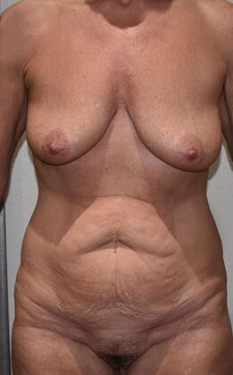 Massive Weight Loss : Case 168 - Before