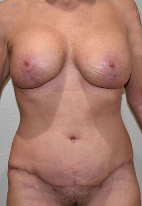 Massive Weight Loss : Case 168 - After