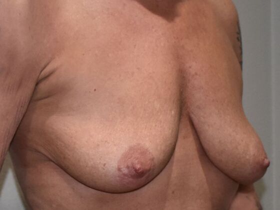 Breast Augmentation w/ Lift: Case 578 - Before