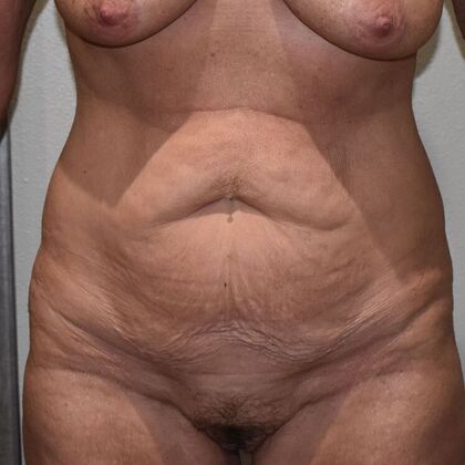 Tummy Tuck (Abdominoplasty): Case 525 - Before